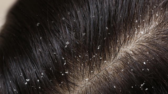 Schuppen in den Haaren
